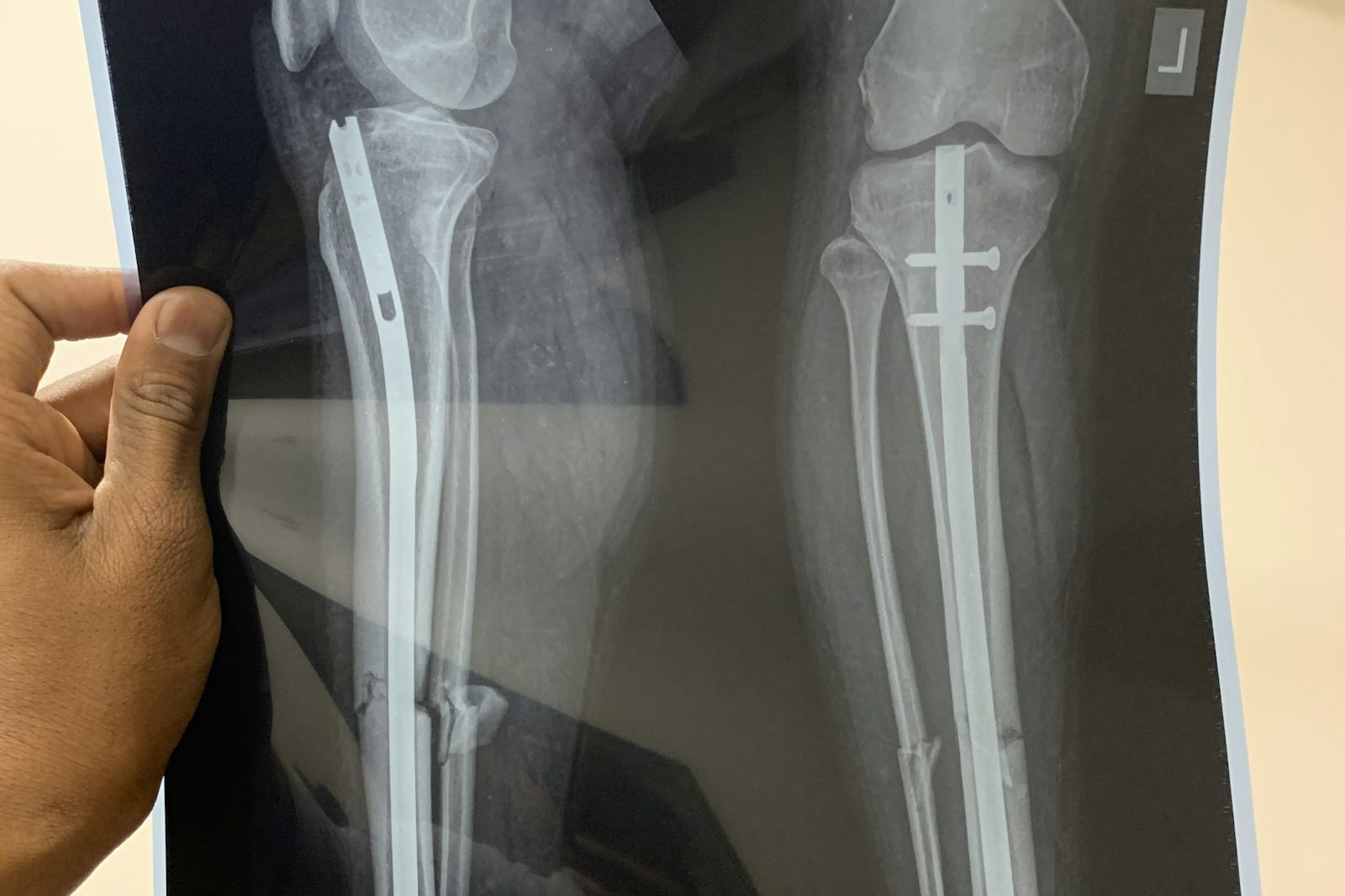 X-ray showing orthopedic hardware.